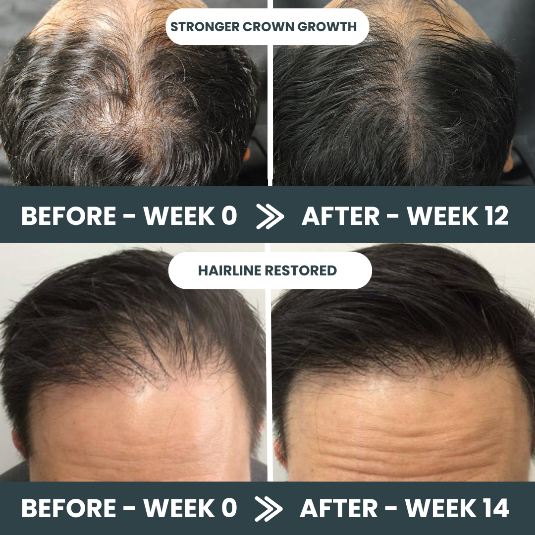Stark One™ - Hair Regrowth Kit