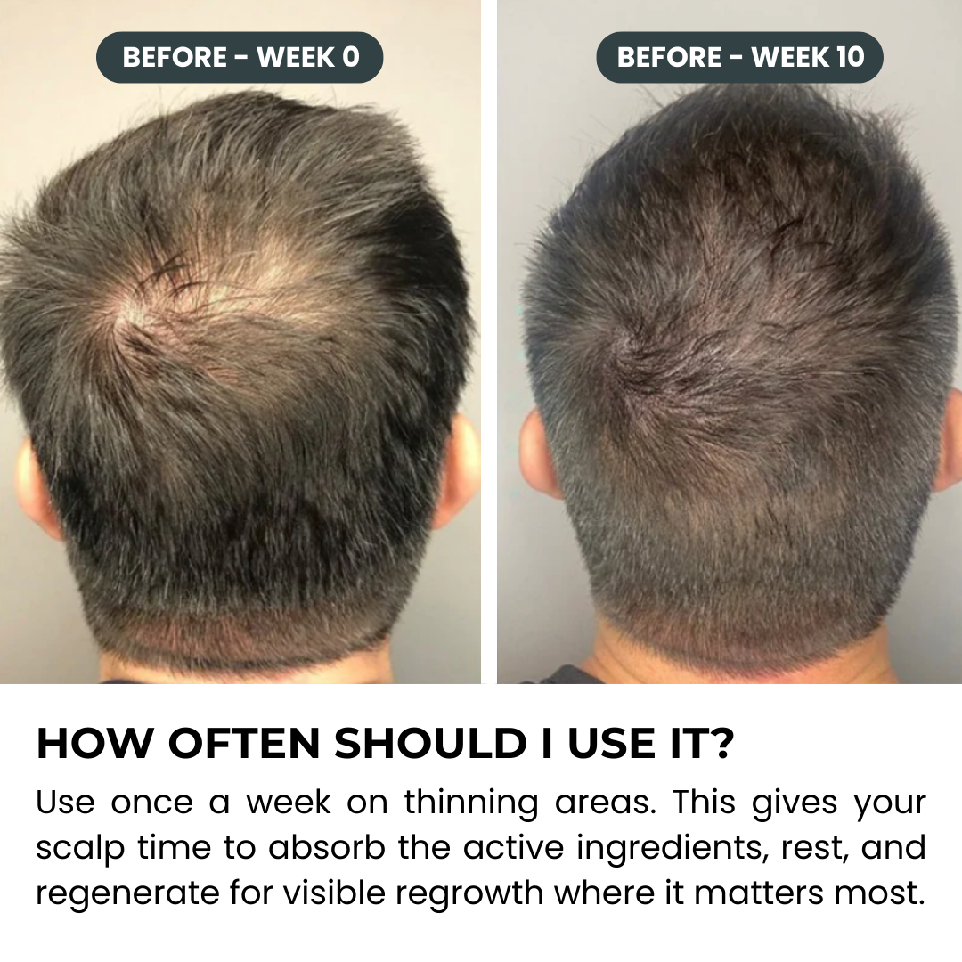Stark One™ Regrowth Kit