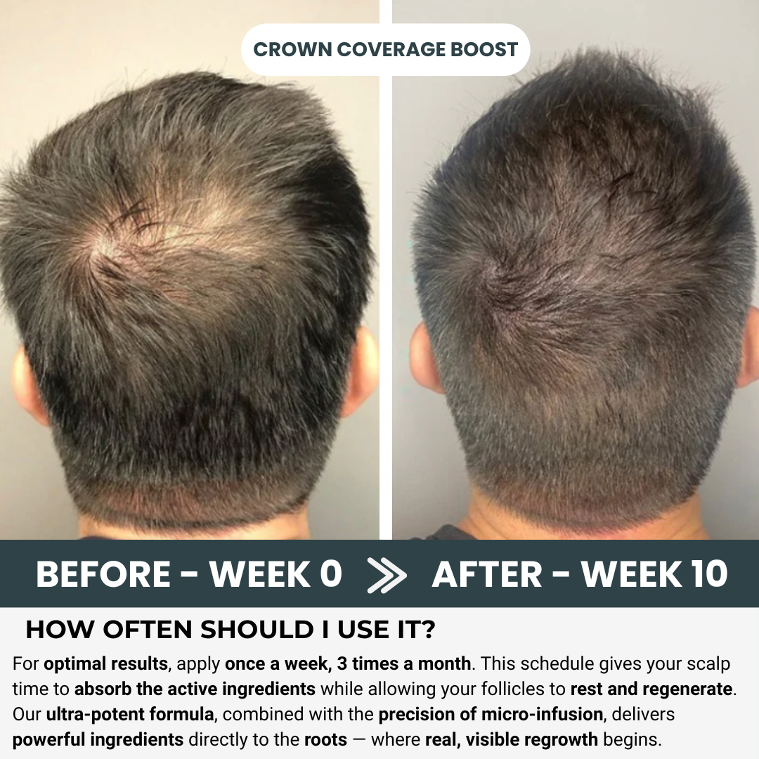 Stark One™ - Hair Regrowth Kit