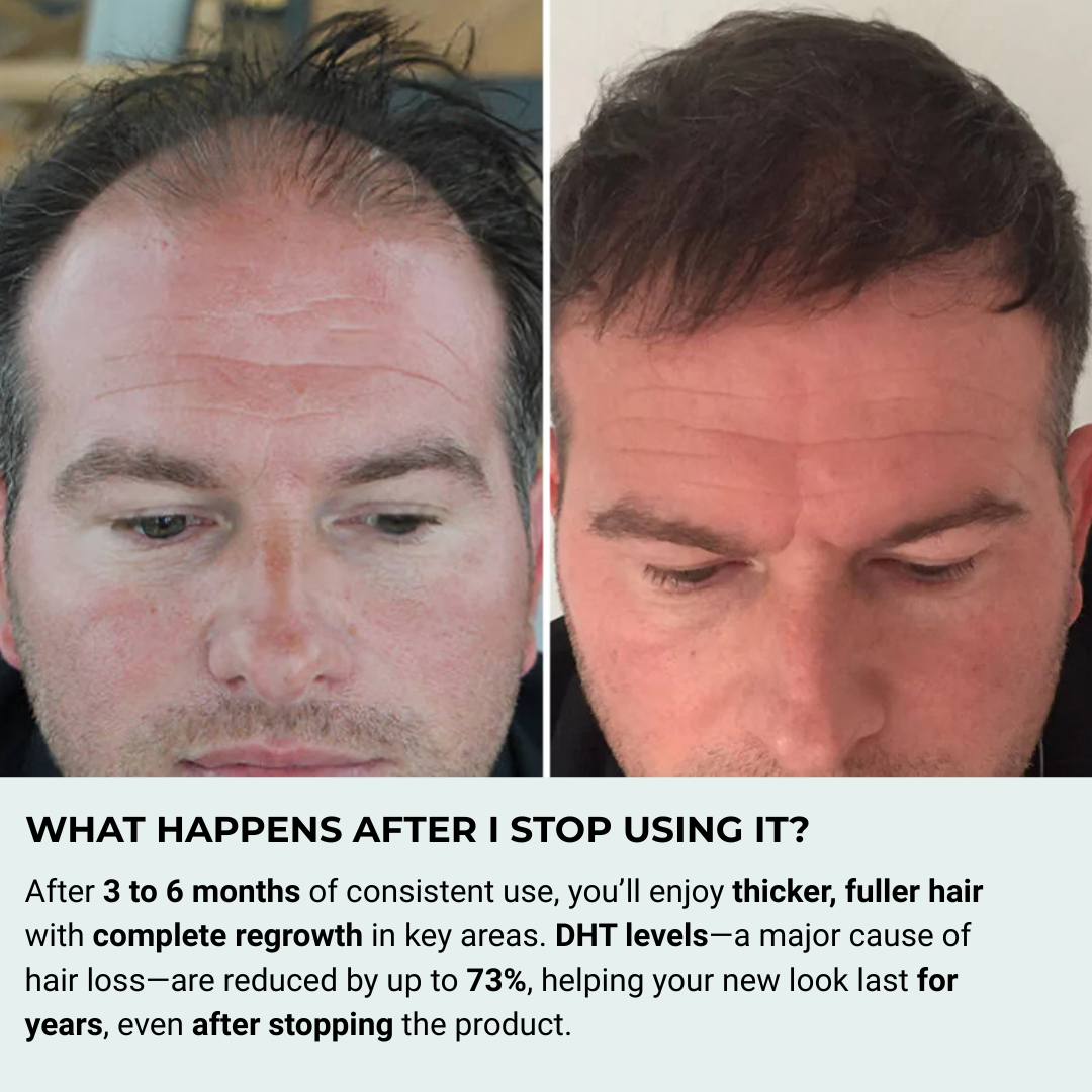 Stark One™ - Hair Regrowth Kit
